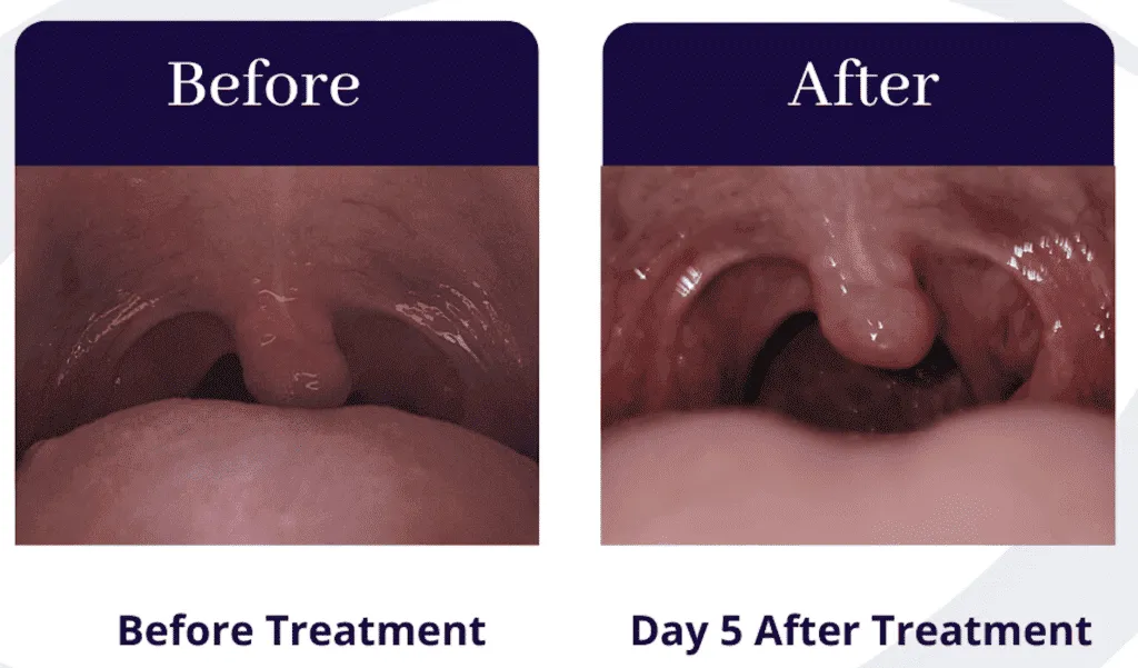 Throat comparison before and on day 5 after treatment, showing significant improvement