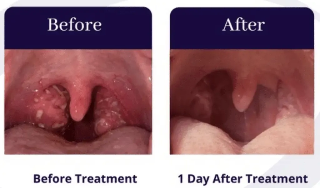 Comparison of throat before and 1 day after treatment, showing reduced inflammation