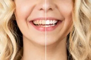 Comparison of dental implant before and after.