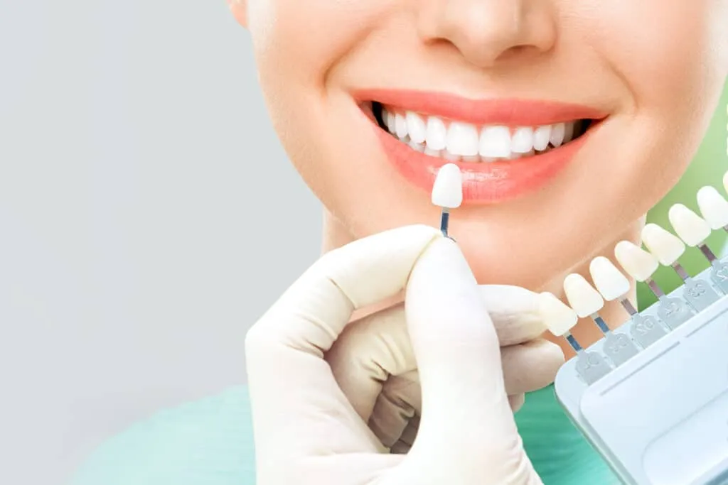 Close-up of a smile with a dentist matching a tooth shade using a dental color guide.
