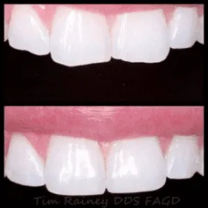 A close-up of a person’s teeth with a bridge.