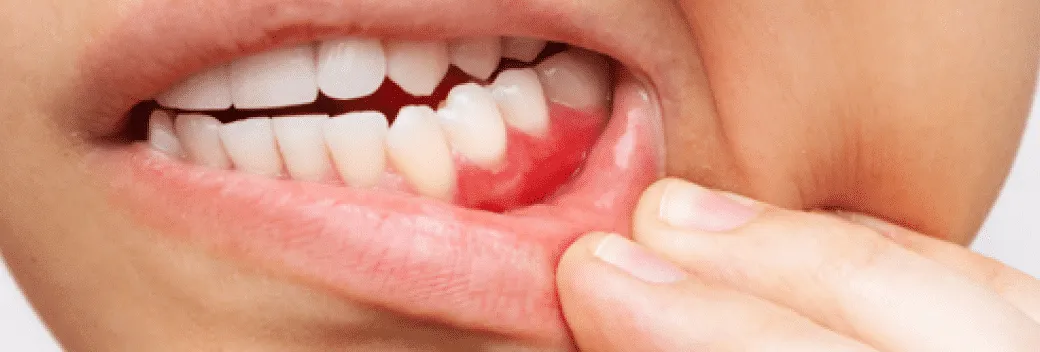 Close-up of teeth and gums