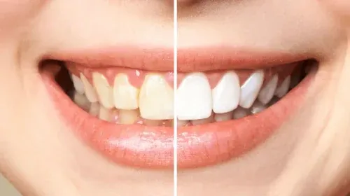image1-1 Teeth Whitening - Comprehensive Family Dental in Victoria Texas