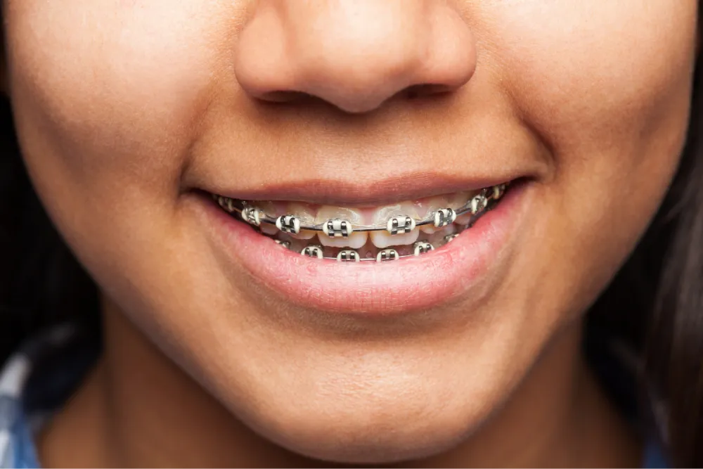 Close-up of a child’s smile with braces