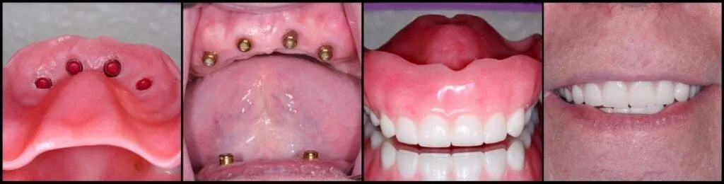 Four-stage dental implant denture process from implant placement to a restored smile