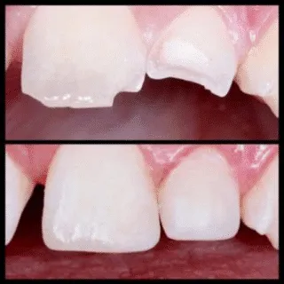 Tooth-Colored Filling — before and after