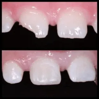 Tooth-Colored Filling — before and after