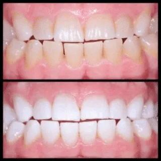 Kor Bleach Whitening — before and after