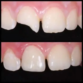 Tooth-Colored Filling — before and after
