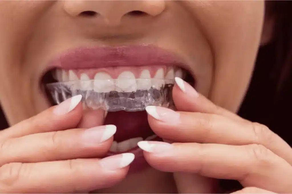 A woman wearing a clear aligner on her teeth.
