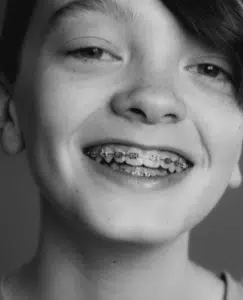 Straighten Teeth Without Braces 1 Image of a woman teeth with braces