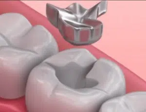Silver fillings increase mercury blood levels up to 150%. 1 A dentist placing a metal crown on a tooth.