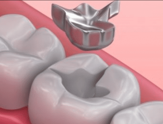 A dentist placing a metal crown on a tooth.