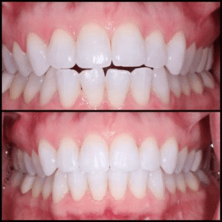 A before-and-after image of a person's teeth, showing the results of dental treatment.