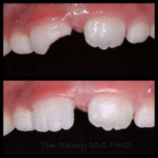 A before-and-after image of a person's teeth, showing the results of dental treatment.