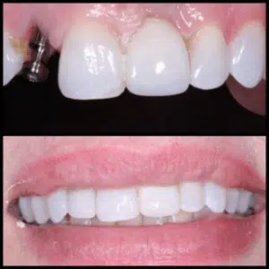How to Choose a Cosmetic Dentist 1 A before-and-after image of a person's teeth, showing the results of dental treatment.