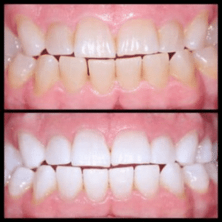 A before-and-after image of a person's teeth