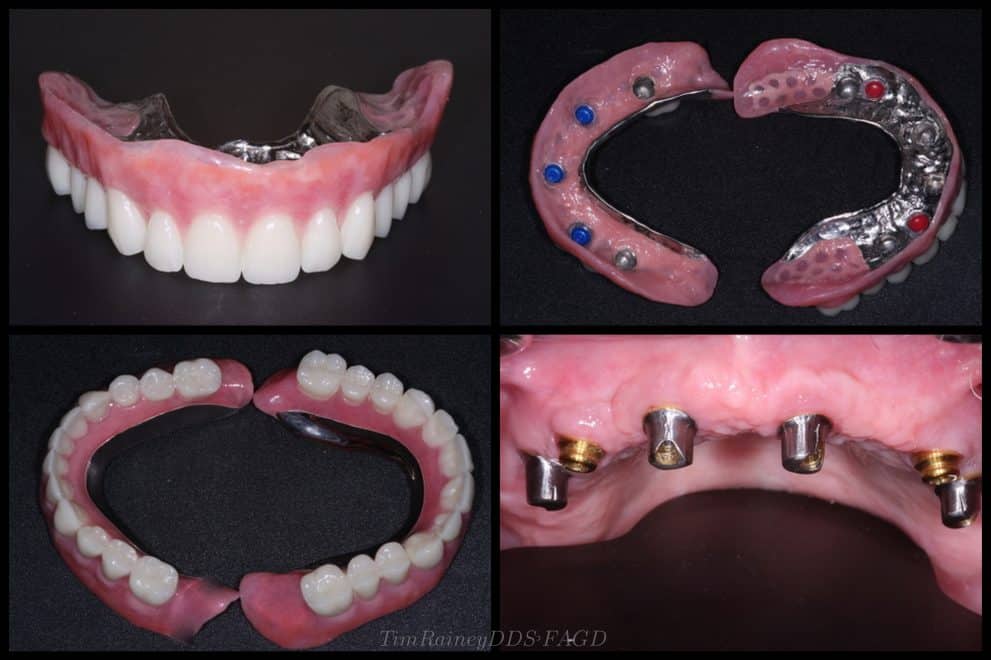 Four dental prosthetic views showcasing dentures.