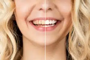 How to whiten your teeth fast. 1 Comparison of dental implant before and after.