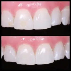 How to whiten your teeth fast. 3 A before and after photo of a person's teeth with yellow stains.