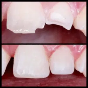 How to prevent crooked teeth and needing braces. 1 A before and after image of a person's teeth. The before image shows the person's teeth with a chipped tooth, and the after image shows the person's teeth with the chipped tooth repaired.