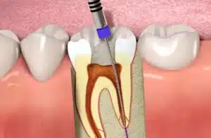 The image shows a dentist using a drill to remove the root of a tooth.