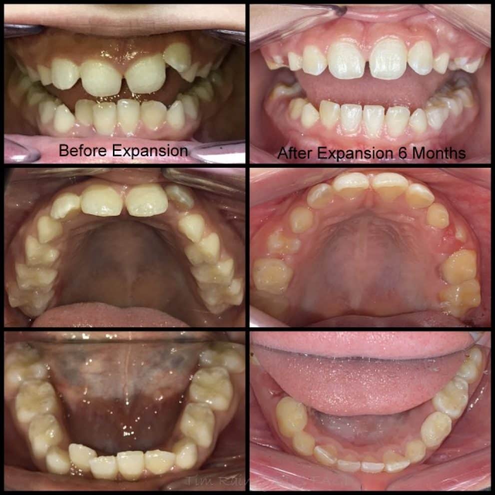 The image shows a before and after photo of a child's teeth. The left photo shows the child's teeth before expansion, and the right photo shows the child's teeth after expansion.