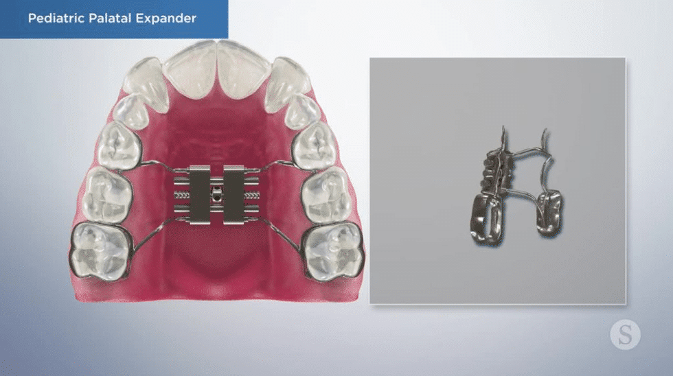 A pediatric palatal expander attached to the roof of a child's mouth
