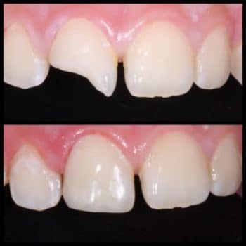 Two before-and-after pictures of a person's teeth.