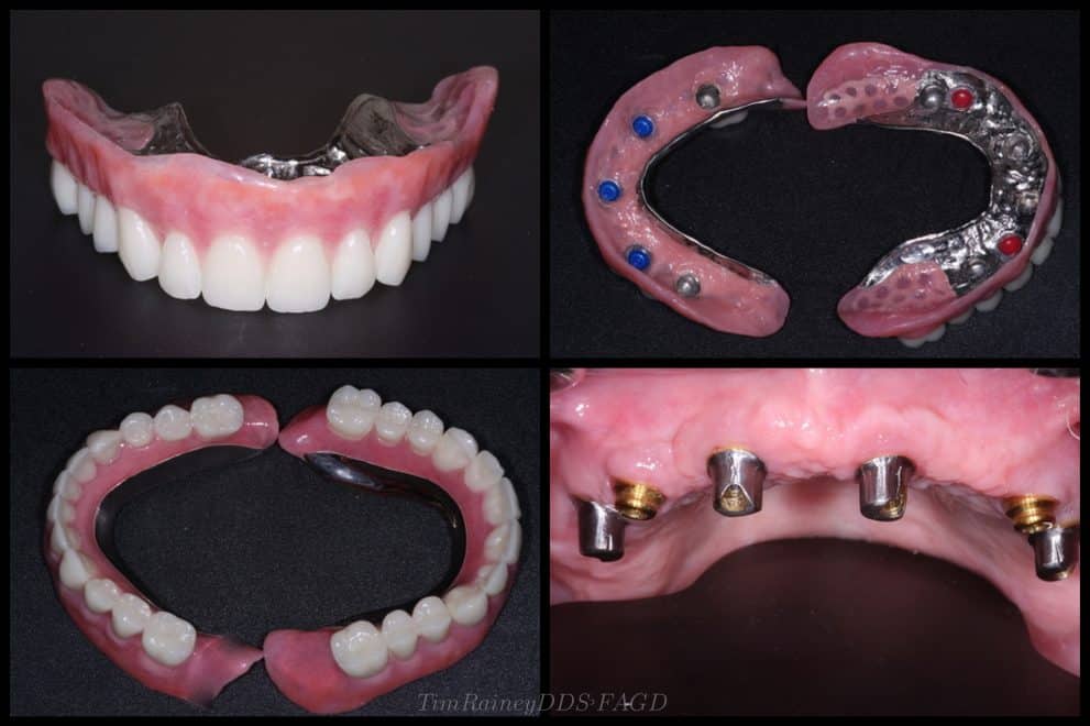 A collage of four photos of dentures.