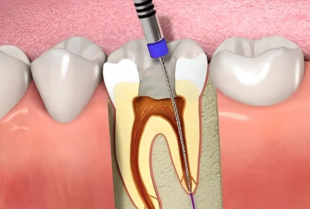 Root Canals Benefits 16 Illustration of a tooth undergoing a root canal procedure.