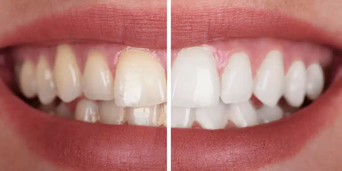Before-and-after photo of teeth whitening. The left photo shows yellowed teeth, and the right photo shows white teeth.