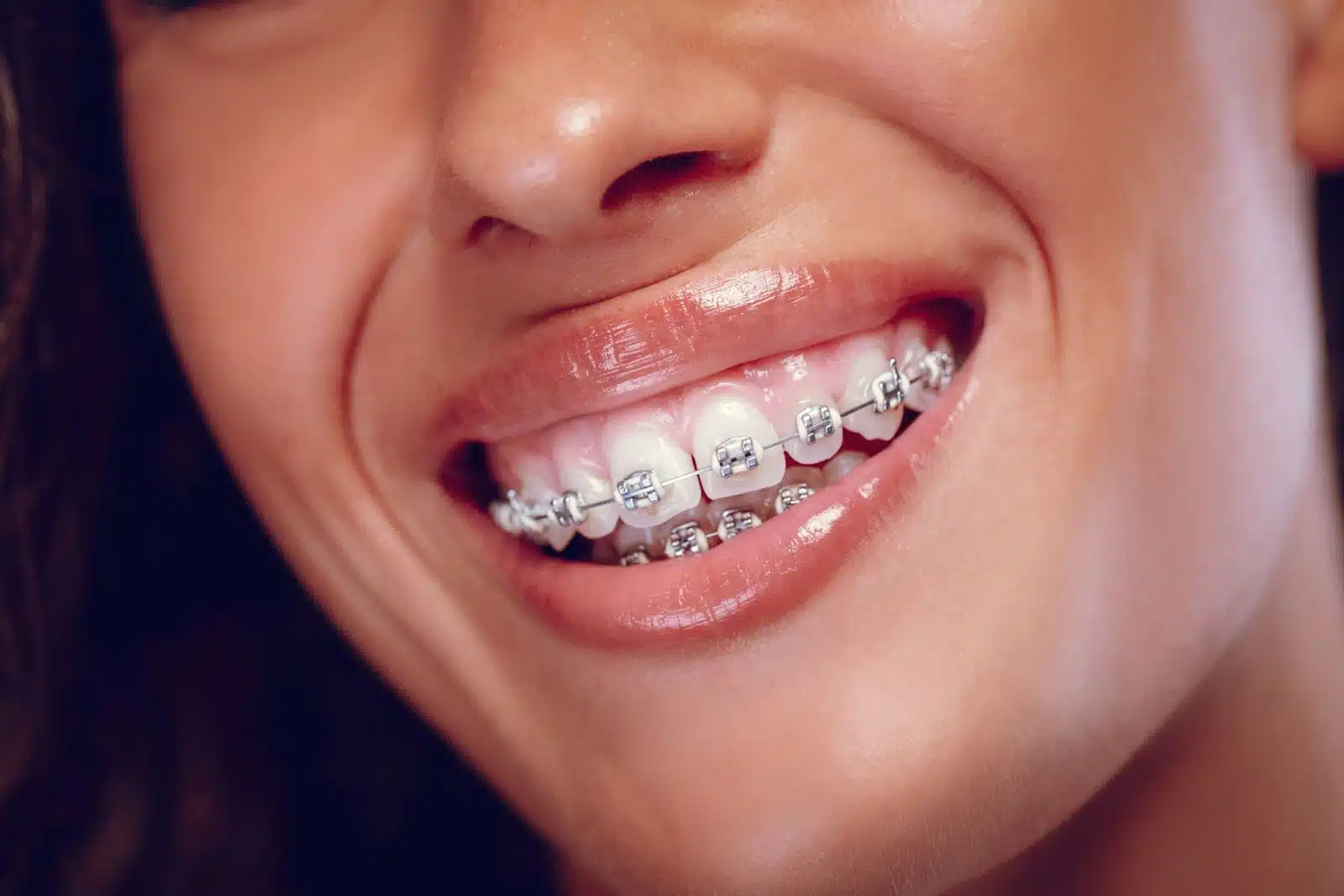 The Negative Side Effects of Tooth Extraction for Braces 1 A close-up of a woman smiling with braces on her teeth.