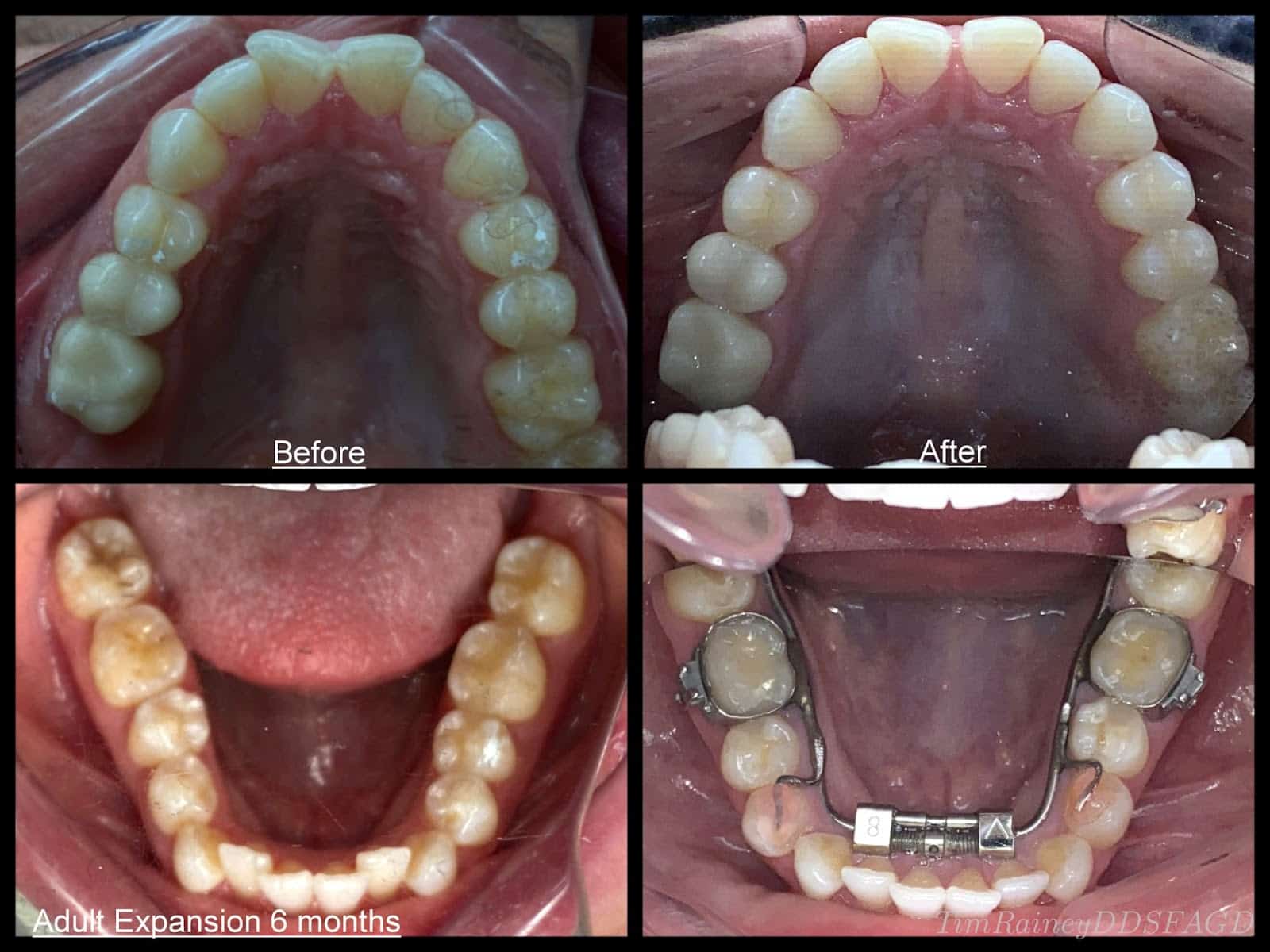 Before and After photos showing an adult mouth using a palatal explander instead of resorting to tooth extraction for their braces.