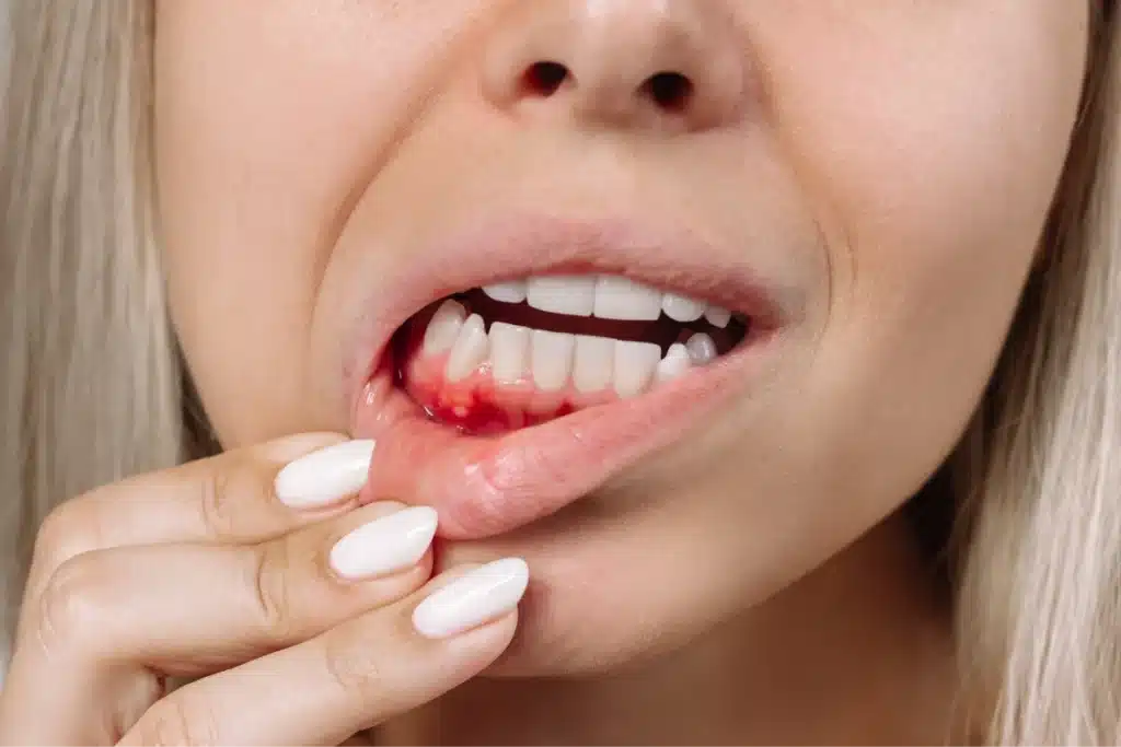 Woman with gingivitis holding lip