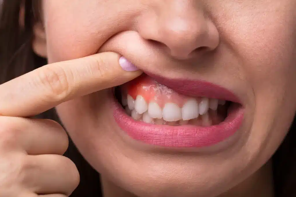 Woman holding her lip showing gum inflammation