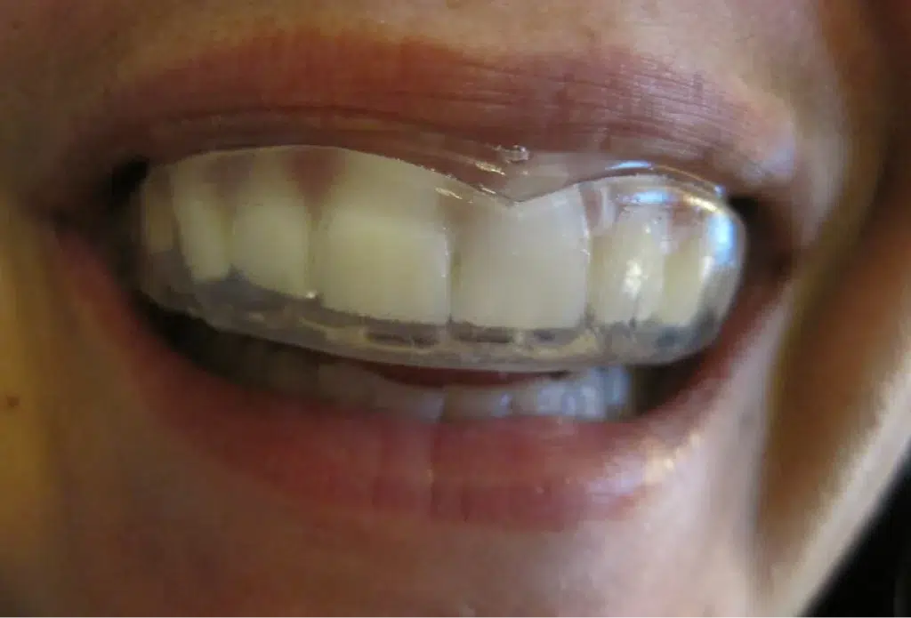 Person with their teeth showing through a mouthguard