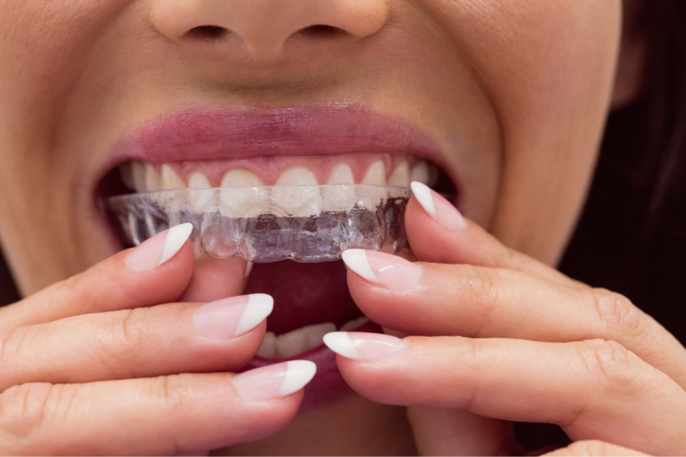 Woman inserting a clear dental aligner.