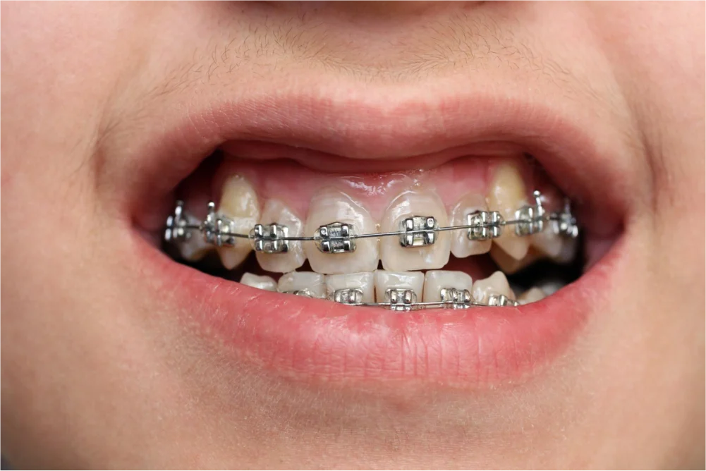 How Long Do You Have to Wear Braces? 2 Child's mouth showing dental braces.