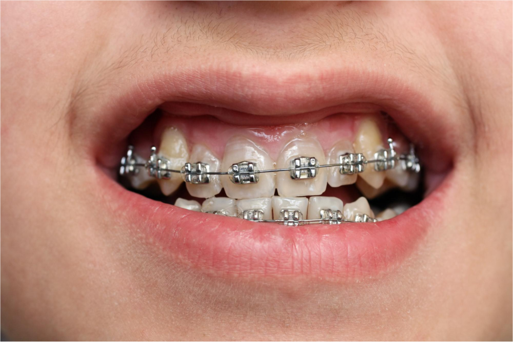 Child's mouth showing dental braces.