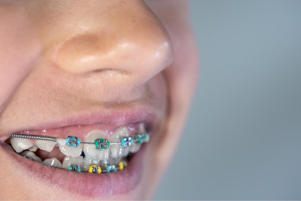 Close-up of colorful dental braces.