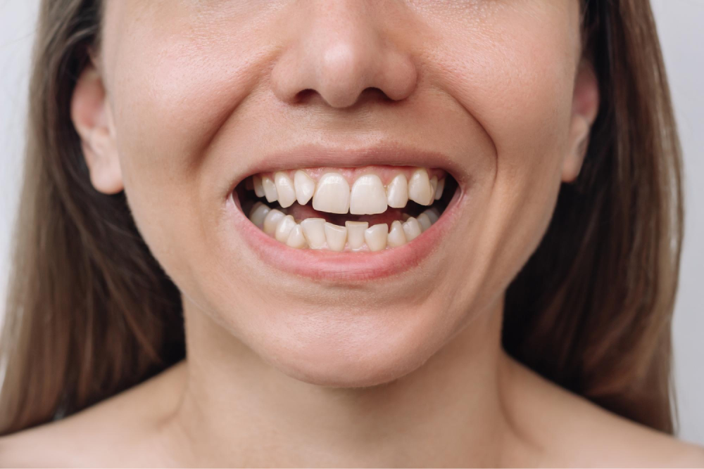 Woman with crooked teeth smiling.