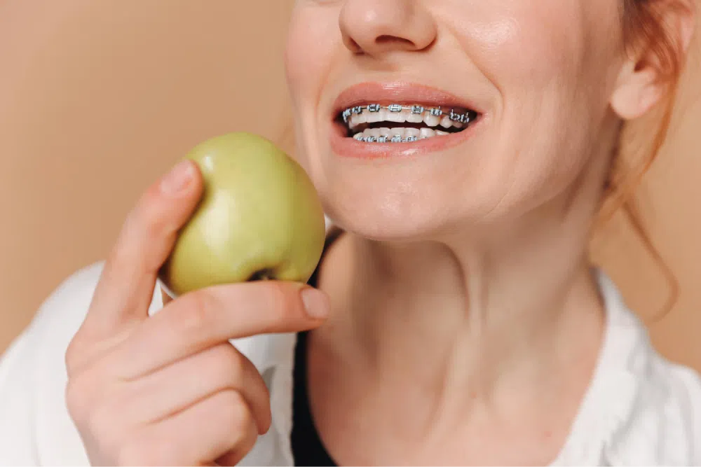 10 Questions You Need Answered Before Getting Braces 3 Woman with braces holding apple.