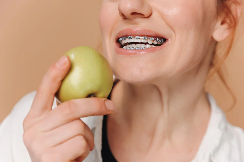 10 Questions You Need Answered Before Getting Braces 3 image5 1