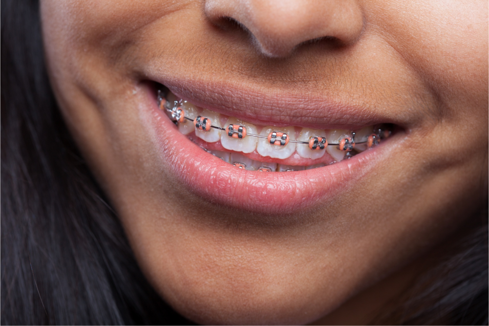 Close-up of smile with braces