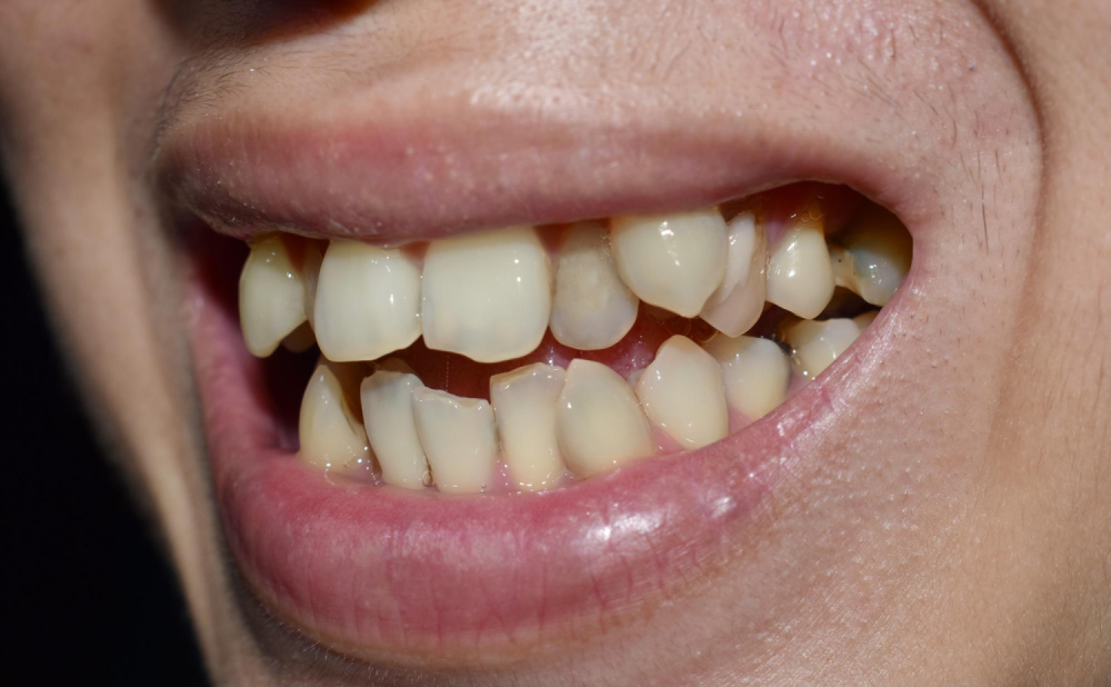 Close-up of crooked yellow teeth.