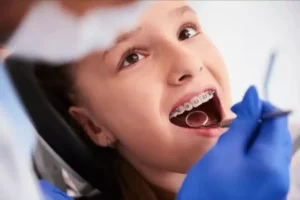 Blog 7 What Parents Need to Know About Palatal Expanders for Kids