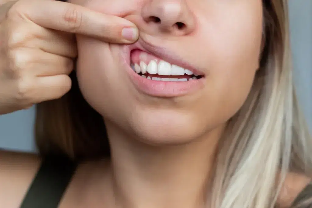 Gum Disease and the Importance of Dental Care