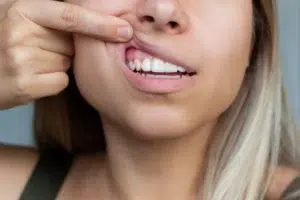 Gum Disease and the Importance of Dental Care