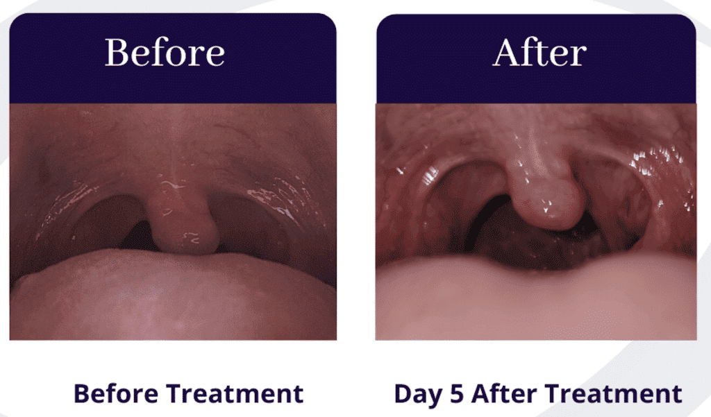 Throat comparison before and on day 5 after treatment, showing significant improvement